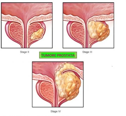 Sospetta eteroplasia prostatica